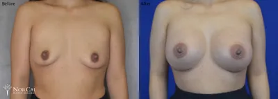 Breast augmentation before and after results - Case 1