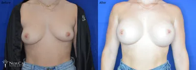 Breast augmentation before and after results - Case 2