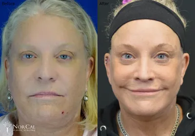 Buccal fat surgery before and after results - Case 1