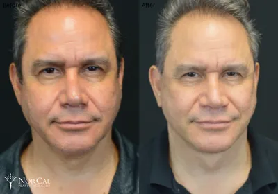 Buccal fat surgery before and after results - Case 2