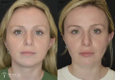 Buccal fat surgery before and after results - Case 3