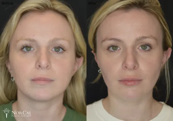 Buccal fat surgery before and after results - Case 3