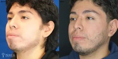 Chin augmentation before and after results - Case 1
