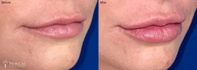 Dermal fillers before and after results - Case 1