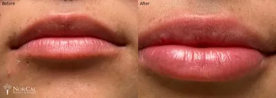 Dermal fillers before and after results - Case 2