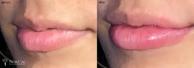 Dermal fillers before and after results - Case 3