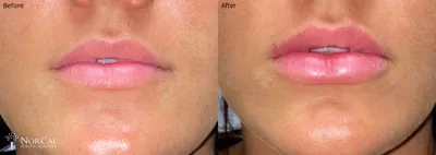 Dermal fillers before and after results - Case 4