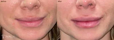 Dermal fillers before and after results - Case 5