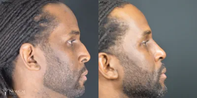 Rhinoplasty before and after results - Case 1