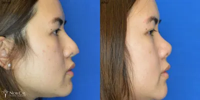 Rhinoplasty before and after results - Case 2