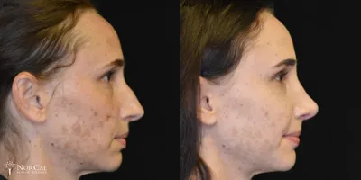 Rhinoplasty before and after results - Case 3