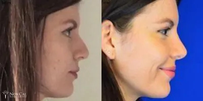 Rhinoplasty before and after results - Case 4