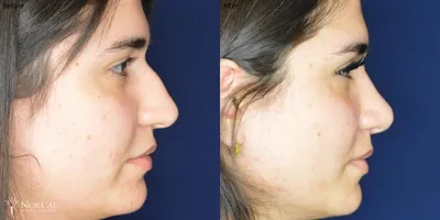Rhinoplasty before and after results - Case 5