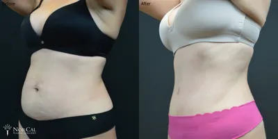 Tummy tuck before and after results - Case 1