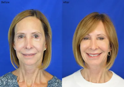 Facial fat grafting before and after results - Case 1