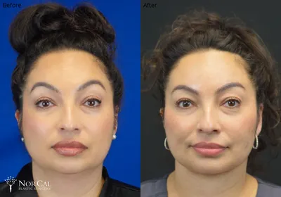 Facial fat grafting before and after results - Case 2