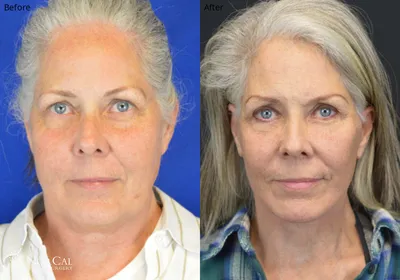 Facial fat grafting before and after results - Case 3