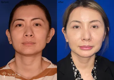 Facial fat grafting before and after results - Case 4