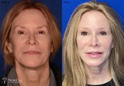 Facial fat grafting before and after results - Case 5