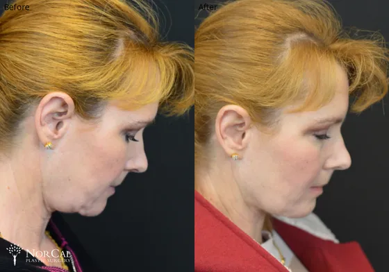 Neck lift before and after results - Case 1