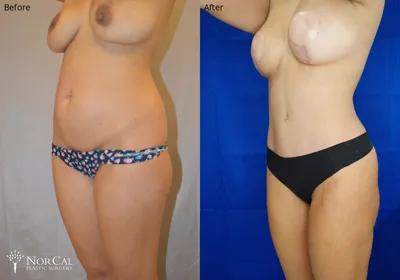 Mommy makeover before and after results - Case 2