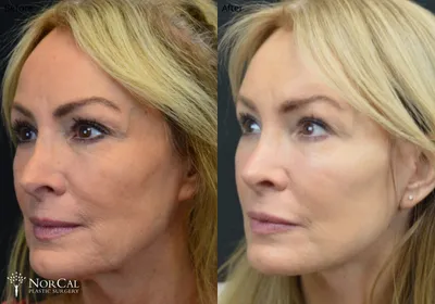 Facelift before and after results - Case 1