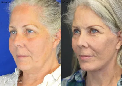 Facelift before and after results - Case 2
