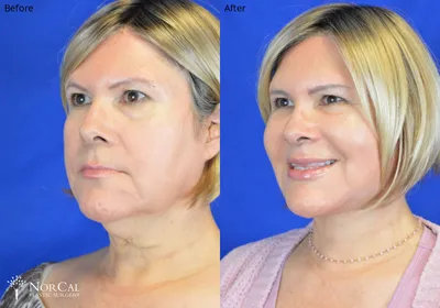 Facelift before and after results - Case 3