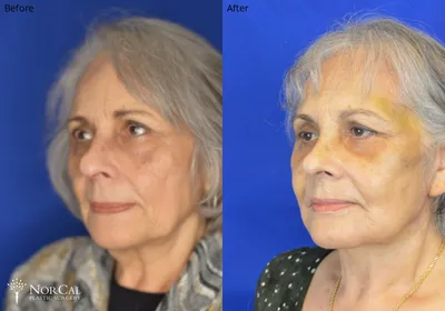 Facelift before and after results - Case 4