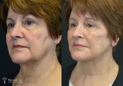 Facelift before and after results - Case 5