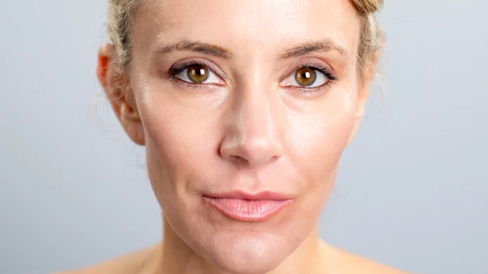 Rhinoplasty patient at NorCal Plastic Surgery