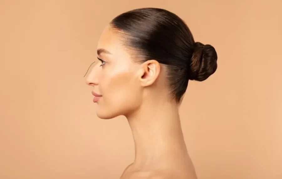What to expect after rhinoplasty norcal plastic surgery sf bay area