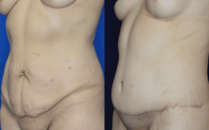 Body Lift Before and After Result Greenbrae