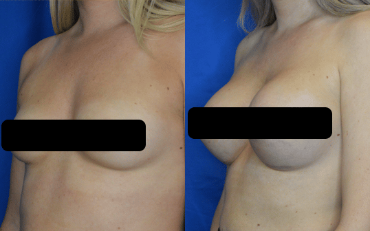 Breast Augmentation Results San Francisco 