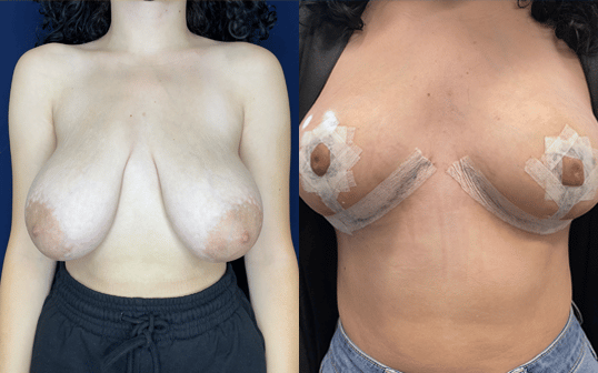 Breast Reduction Before and After Result Greenbrae