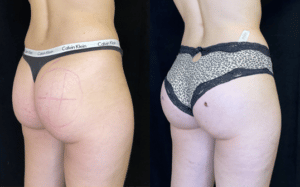 Butt Augmentation Before and After Result Greenbrae