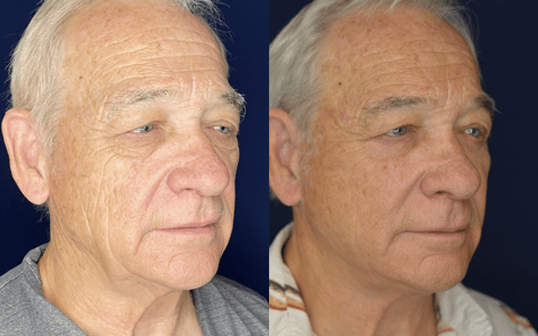 Mini Facelift Results Greenbrae