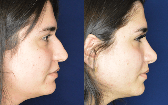 Rhinoplasty Before and After Result Greenbrae