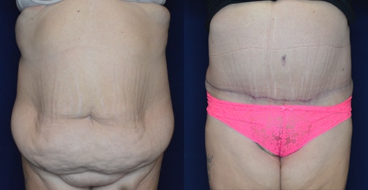 Before and After Image Body Procedure Tummy Tack