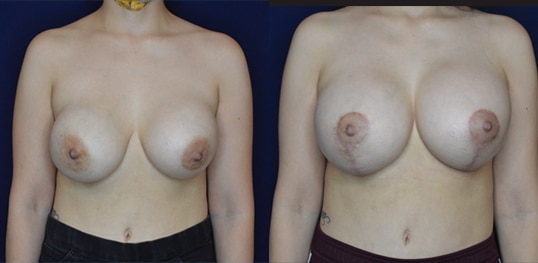 before and after image breast lift