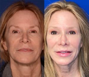 before-and-after-image-facial-fat-laser