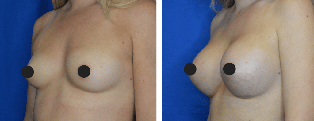 Fat Transfer Breast Augmentation Results Bay Area