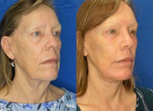 Face & Neck Lift Before and After Result Greenbrae