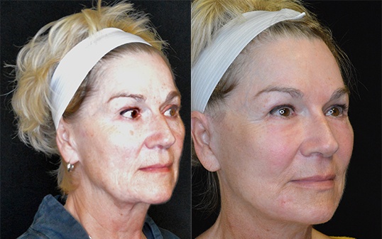 Facelift Before and After Greenbrae